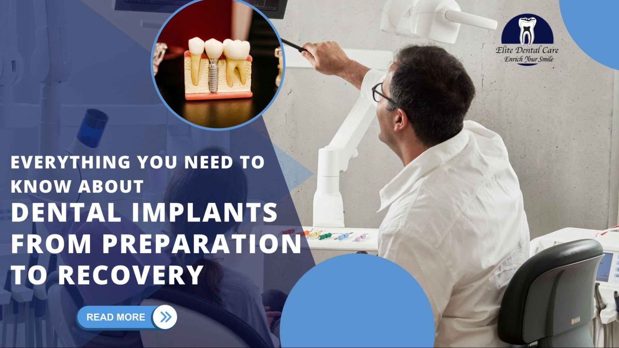 A dental professional uses a model to explain dental implants in a modern clinic with the blog title highlighted